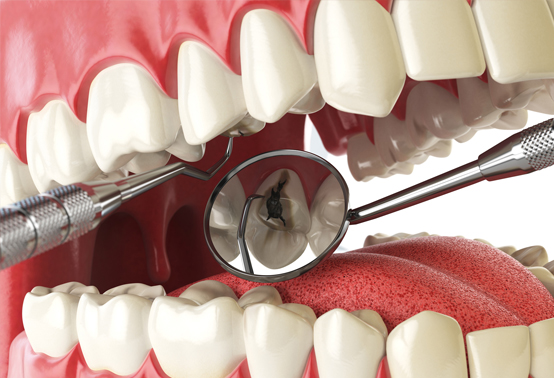Diş Hastalıkları Ve Tedavisi